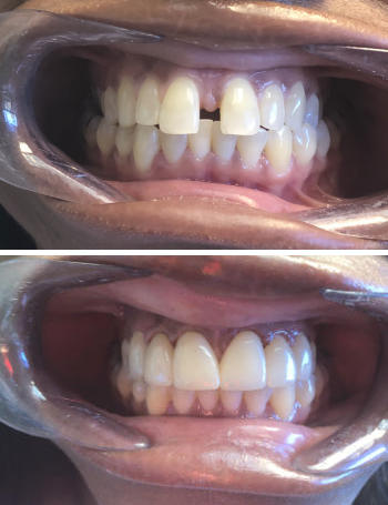 Close-up views of a person's open mouth showing upper and lower teeth.