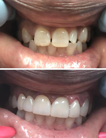 Before and after photographs of dental veneers installation.