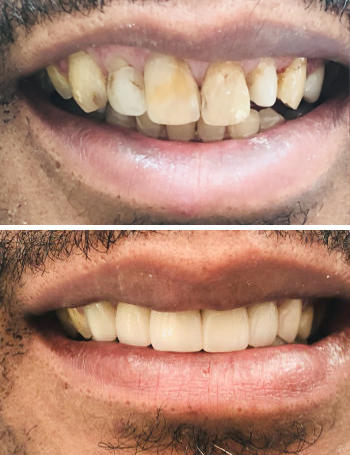 Before and after teeth whitening treatment.