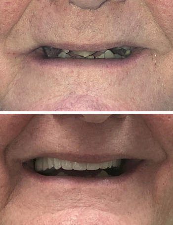Before and after dental treatment showing improved teeth appearance.