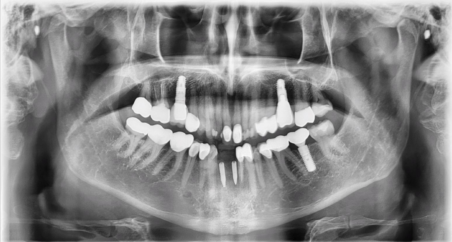 X-ray shows that an implant was placed after the extraction of broken teeth