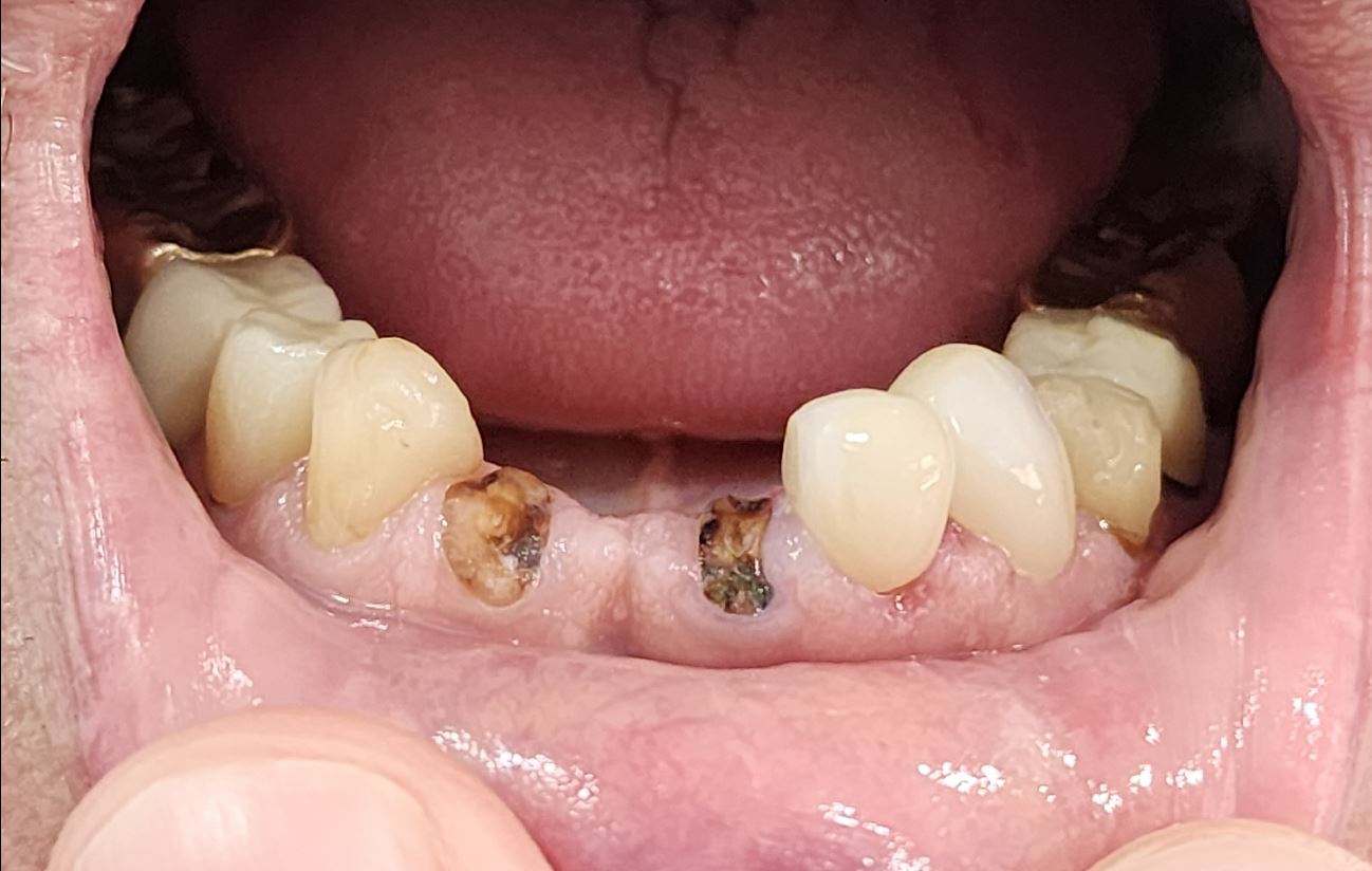 patient missing their lower front teeth